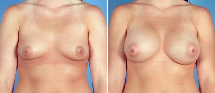 Before & After Breast Augmentation Case 17612 View #1 View in Alpharetta, GA
