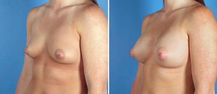 Before & After Breast Augmentation Case 17612 View #2 View in Alpharetta, GA