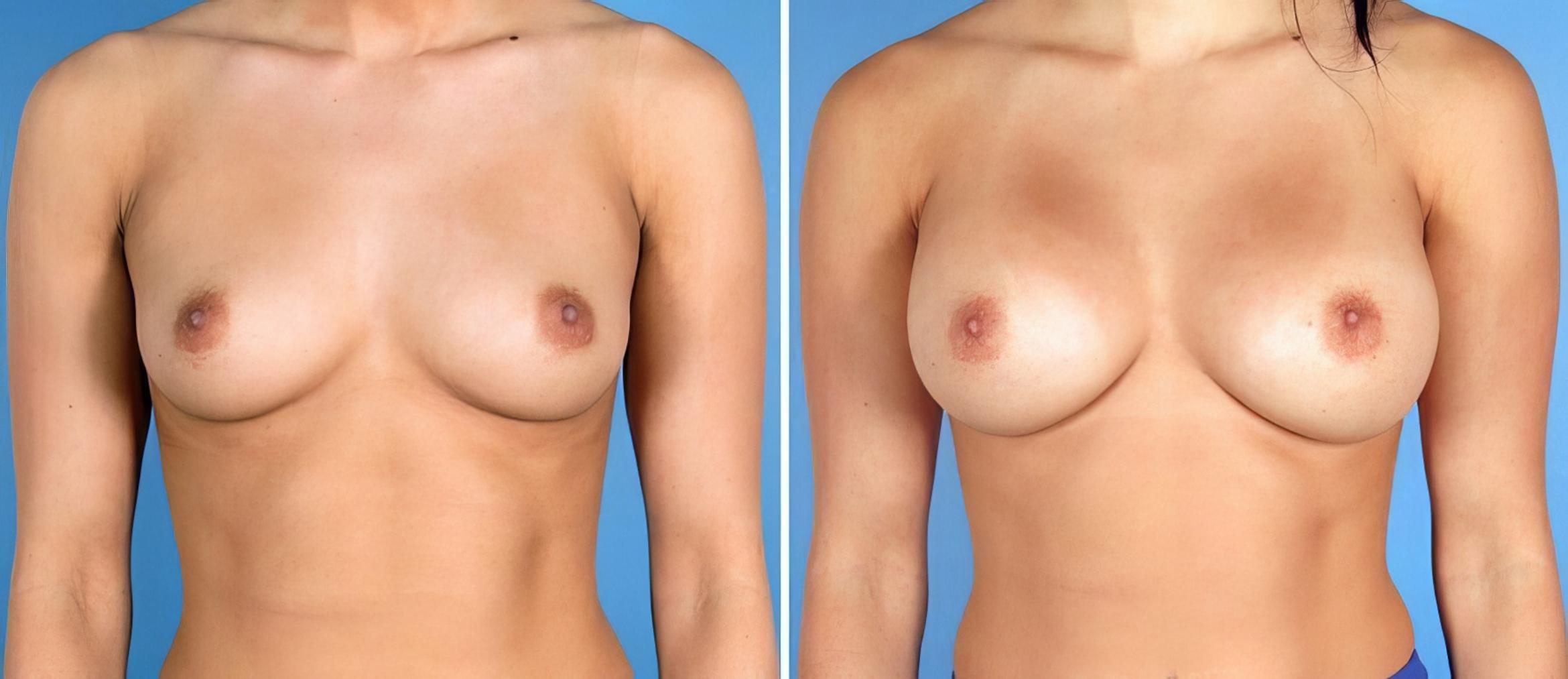 Before & After Breast Augmentation Case 17618 View #1 View in Alpharetta, GA