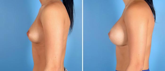 Before & After Breast Augmentation Case 17618 View #2 View in Alpharetta, GA