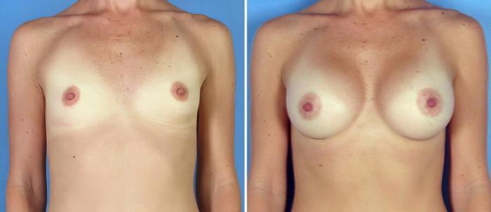 Before & After Breast Augmentation Case 17760 View #1 View in Alpharetta, GA