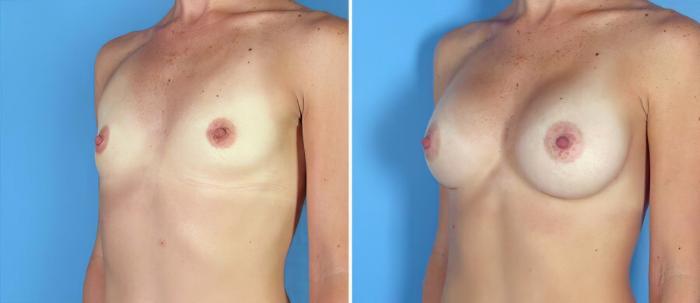 Before & After Breast Augmentation Case 17760 View #2 View in Alpharetta, GA