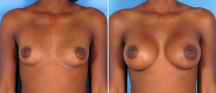 Before & After Breast Augmentation Case 17818 View #1 View in Alpharetta, GA