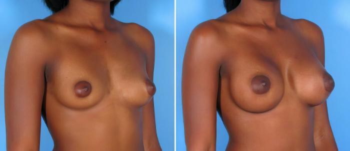 Before & After Breast Augmentation Case 17818 View #2 View in Alpharetta, GA