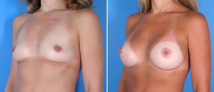 Before & After Breast Augmentation Case 17829 View #2 View in Alpharetta, GA