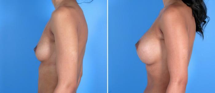Before & After Breast Augmentation Case 17832 View #2 View in Alpharetta, GA