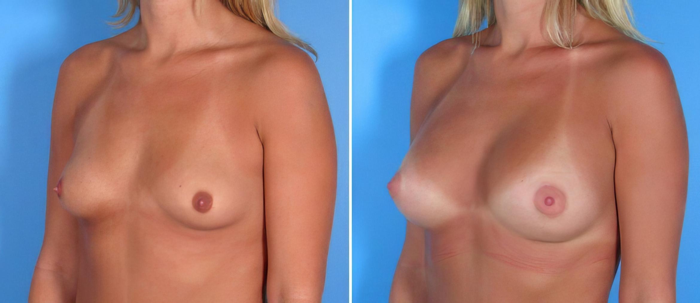 Before & After Breast Augmentation Case 17841 View #1 View in Alpharetta, GA