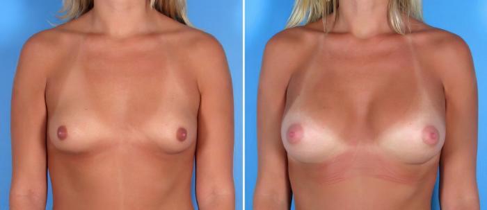 Before & After Breast Augmentation Case 17841 View #2 View in Alpharetta, GA