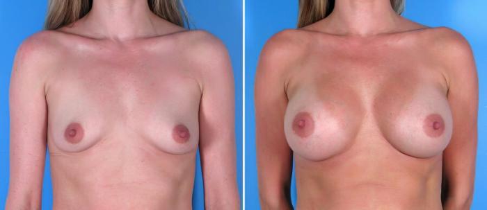 Before & After Breast Augmentation Case 17844 View #1 View in Alpharetta, GA