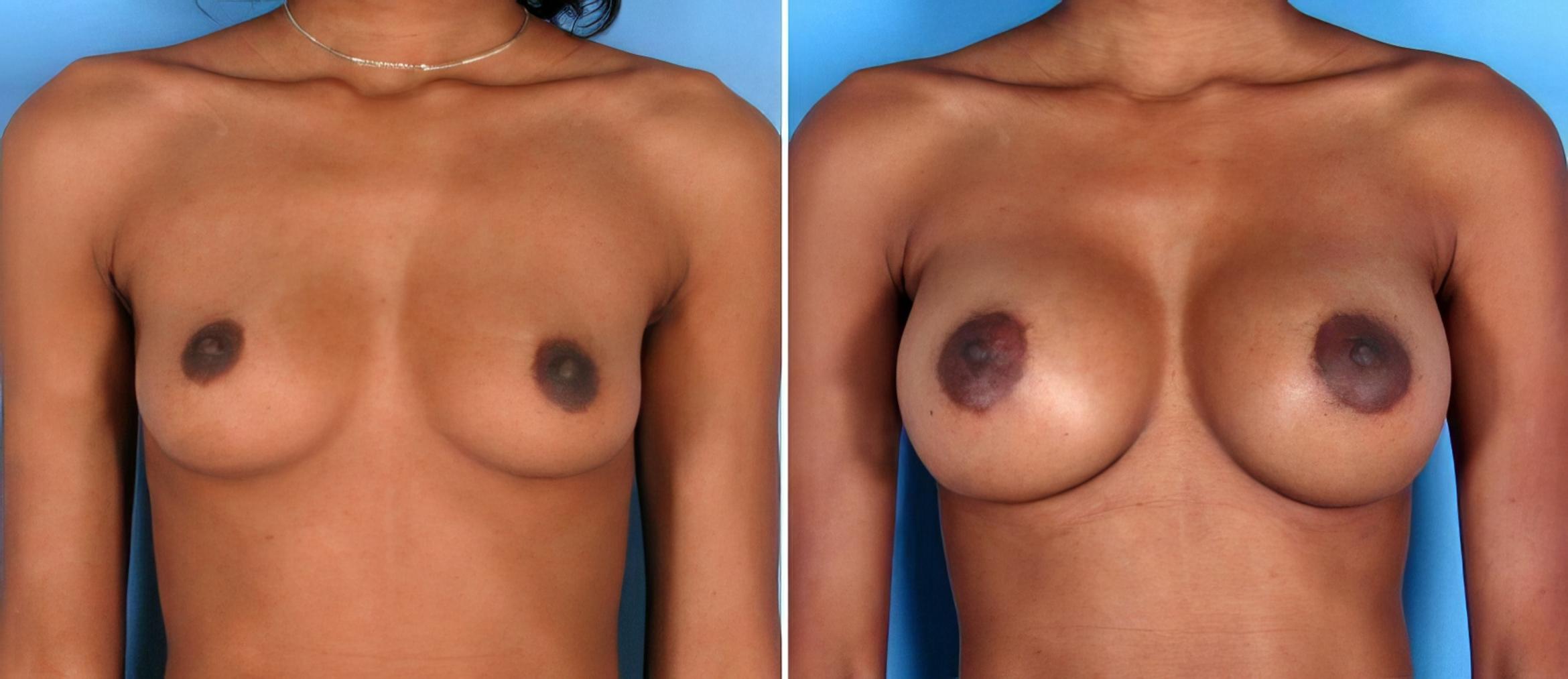 Before & After Breast Augmentation Case 17850 View #1 View in Alpharetta, GA