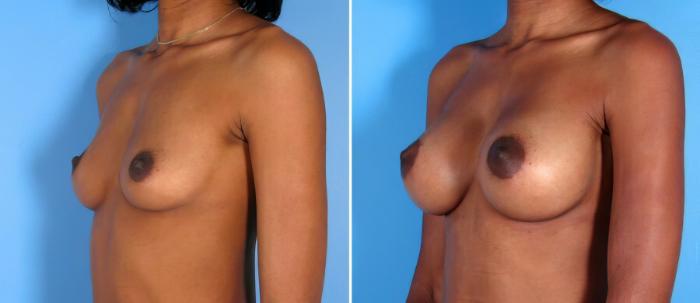 Before & After Breast Augmentation Case 17850 View #2 View in Alpharetta, GA