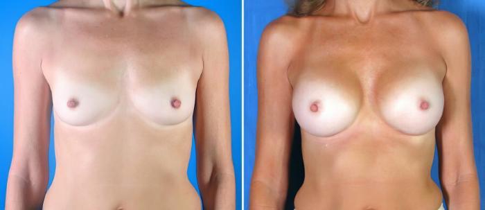 Before & After Breast Augmentation Case 17853 View #2 View in Alpharetta, GA