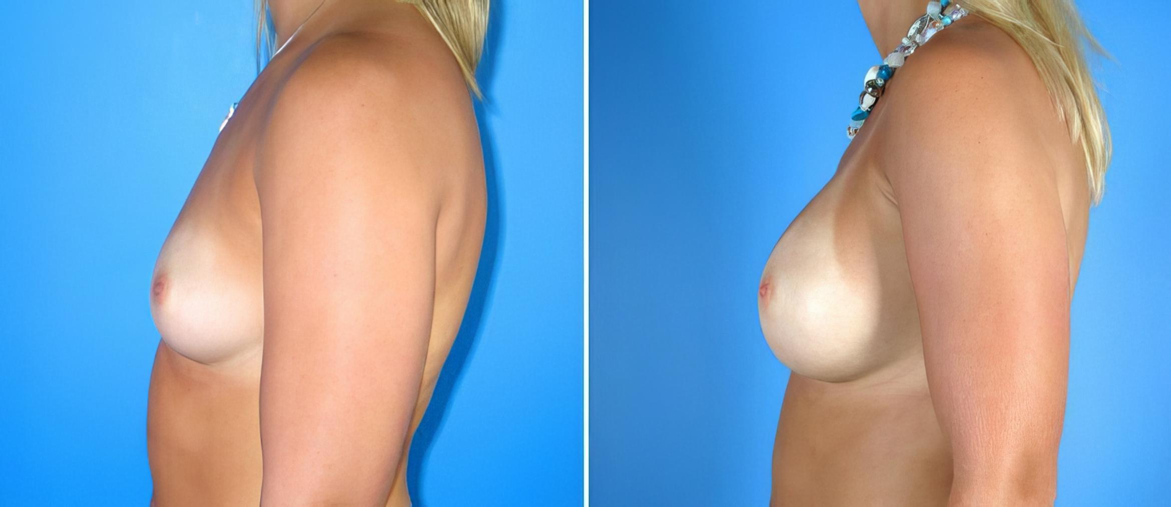 Before & After Breast Augmentation Case 17859 View #1 View in Alpharetta, GA