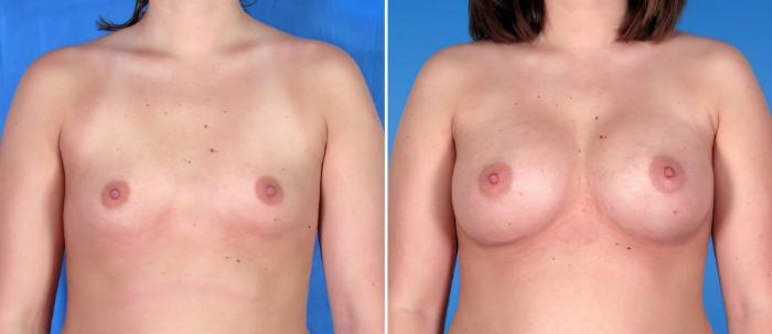 Before & After Breast Augmentation Case 17865 View #2 View in Alpharetta, GA