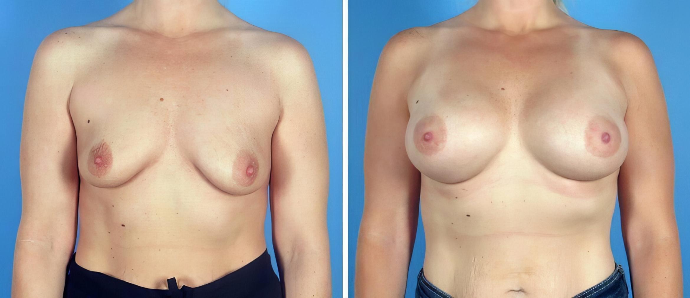 Before & After Breast Augmentation Case 19221 View #1 View in Alpharetta, GA