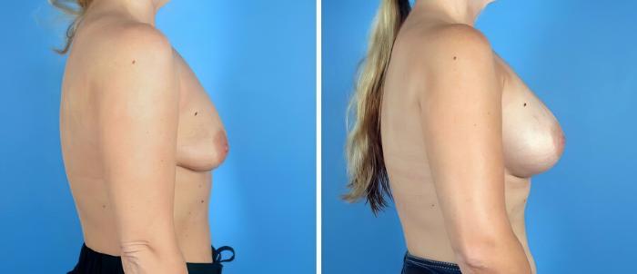 Before & After Breast Augmentation Case 19221 View #2 View in Alpharetta, GA