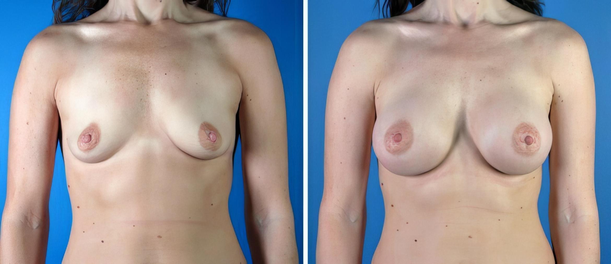 Before & After Breast Augmentation Case 19231 View #1 View in Alpharetta, GA