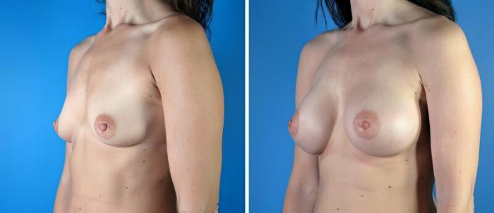 Before & After Breast Augmentation Case 19231 View #2 View in Alpharetta, GA