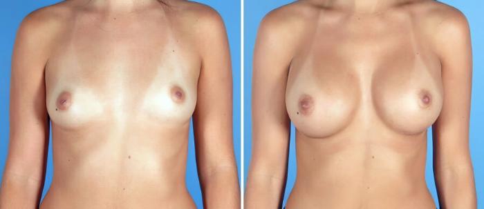 Before & After Breast Augmentation Case 19275 View #1 View in Alpharetta, GA