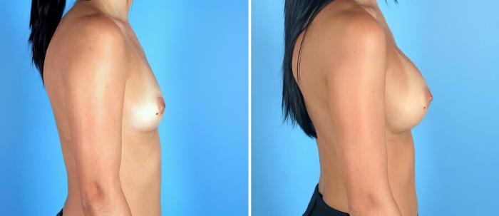 Before & After Breast Augmentation Case 19275 View #2 View in Alpharetta, GA