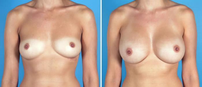 Before & After Breast Augmentation Case 19278 View #1 View in Alpharetta, GA