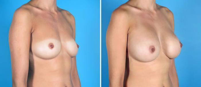 Before & After Breast Augmentation Case 19278 View #2 View in Alpharetta, GA