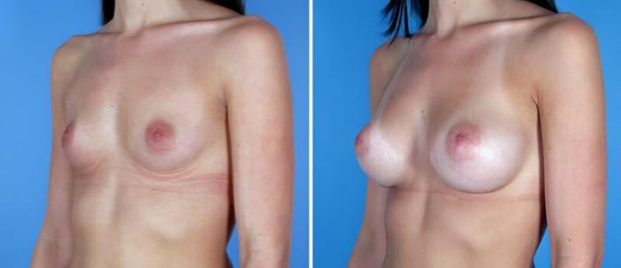 Before & After Breast Augmentation Case 19352 View #2 View in Alpharetta, GA