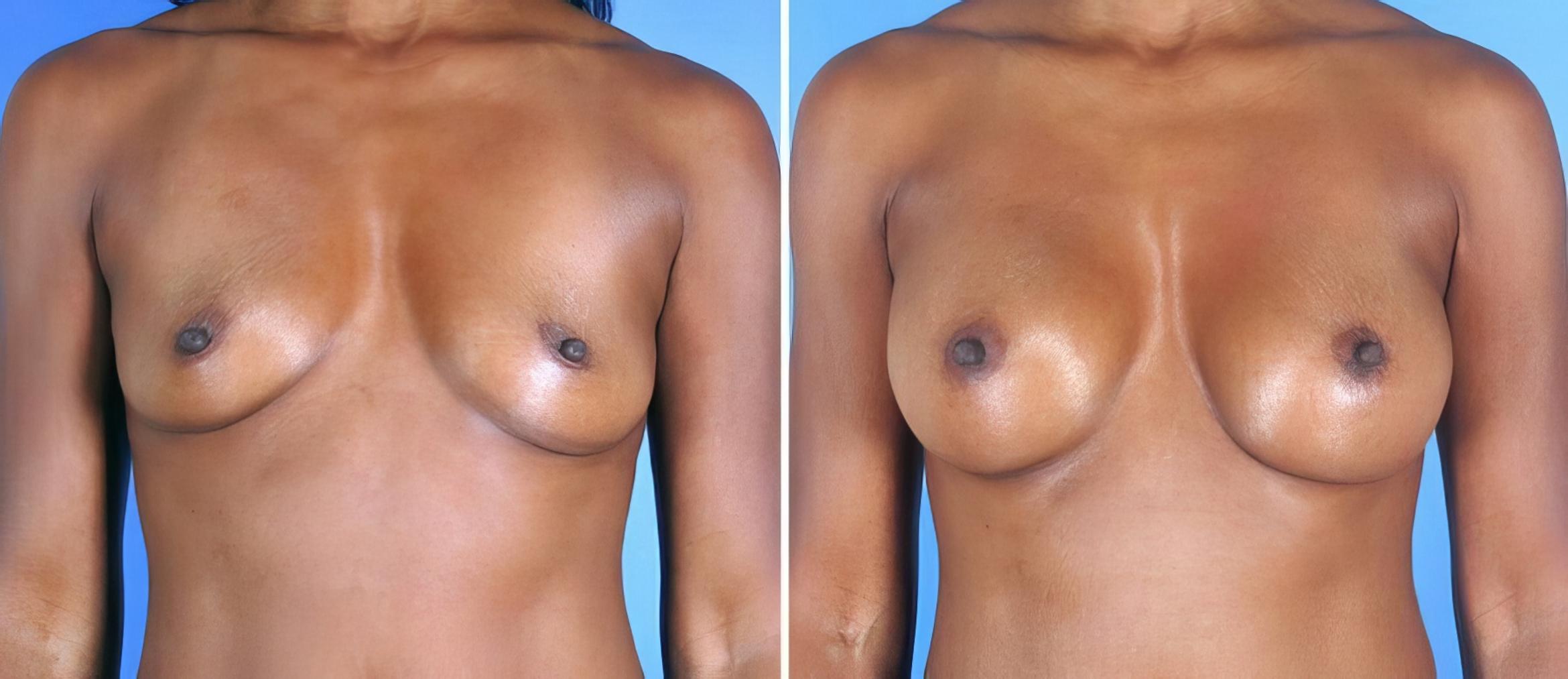 Before & After Breast Augmentation Case 19355 View #1 View in Alpharetta, GA