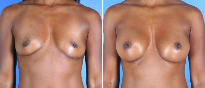 Before & After Breast Augmentation Case 19355 View #1 View in Alpharetta, GA