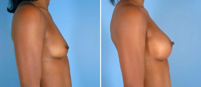 Before & After Breast Augmentation Case 19355 View #2 View in Alpharetta, GA
