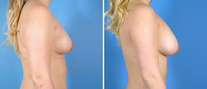 Before & After Breast Augmentation Case 19863 View #2 View in Alpharetta, GA