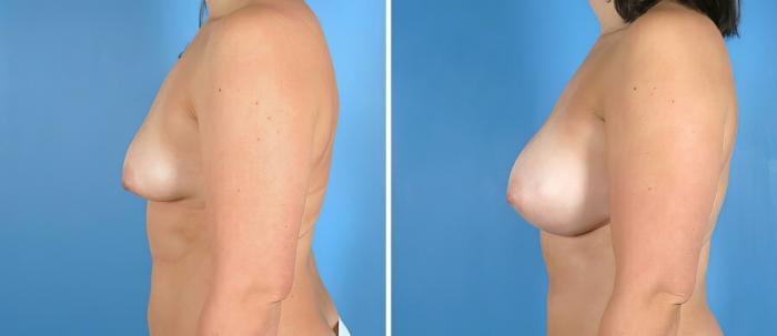 Before & After Breast Augmentation Case 19866 View #2 View in Alpharetta, GA