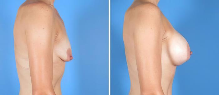Before & After Breast Augmentation Case 19872 View #2 View in Alpharetta, GA