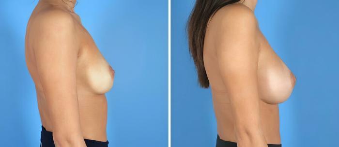 Before & After Breast Augmentation Case 19876 View #2 View in Alpharetta, GA