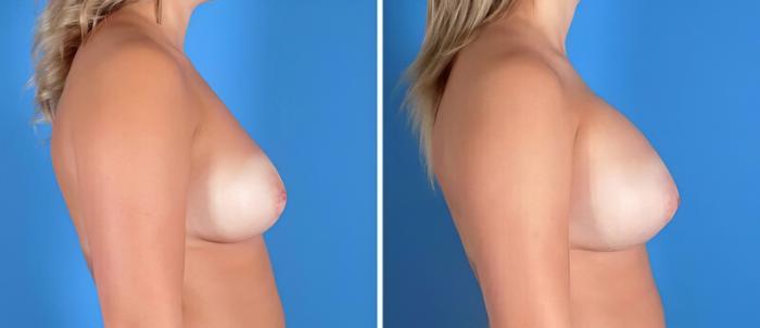 Before & After Breast Augmentation Case 22915 View #2 View in Alpharetta, GA