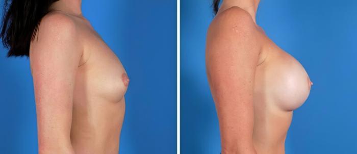 Before & After Breast Augmentation Case 22924 View #2 View in Alpharetta, GA