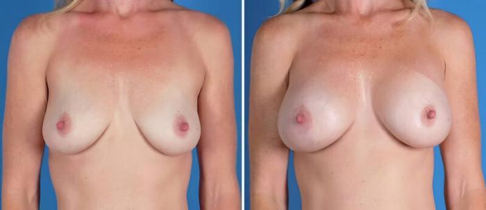 Before & After Breast Augmentation Case 22943 View #1 View in Alpharetta, GA