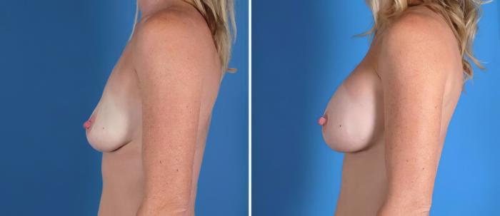 Before & After Breast Augmentation Case 22943 View #2 View in Alpharetta, GA