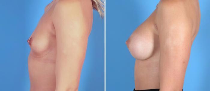 Before & After Breast Augmentation Case 24876 View #2 View in Alpharetta, GA