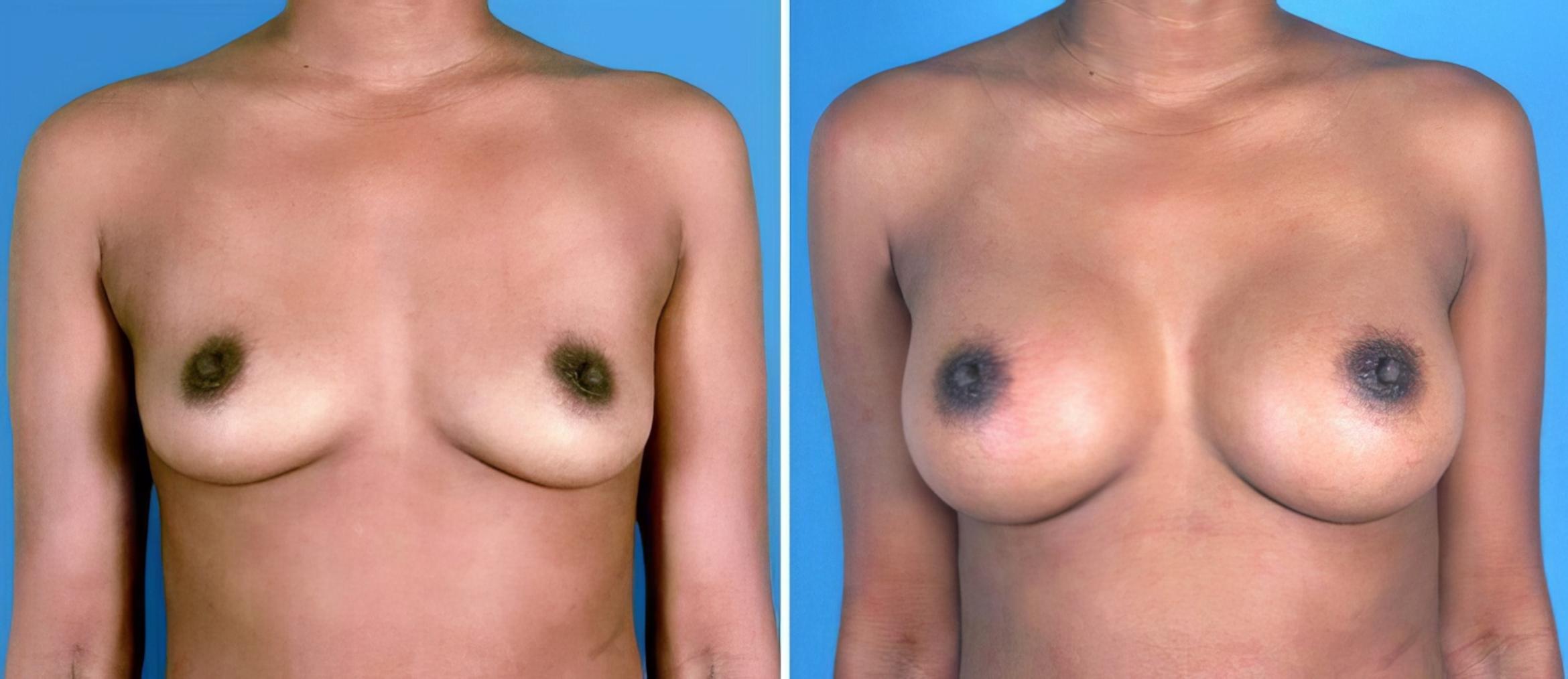 Before & After Breast Augmentation Case 24879 View #1 View in Alpharetta, GA