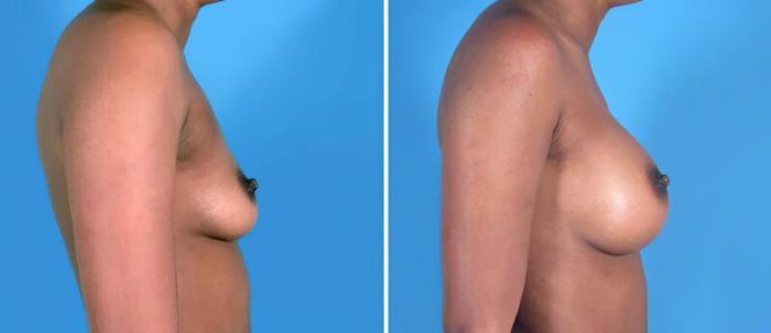 Before & After Breast Augmentation Case 24879 View #2 View in Alpharetta, GA
