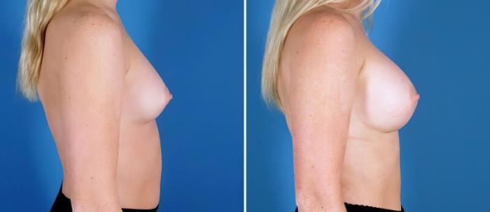 Before & After Breast Augmentation Case 24882 View #2 View in Alpharetta, GA