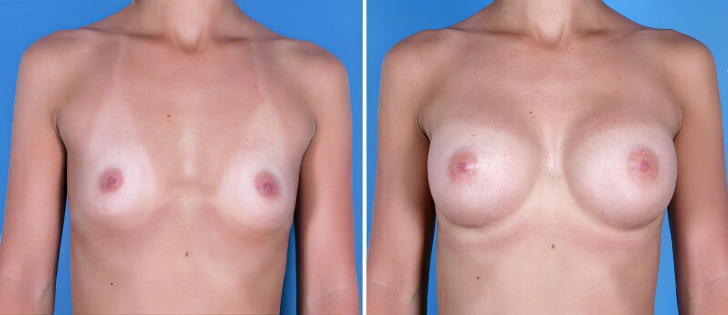Before & After Breast Augmentation Case 24885 View #1 View in Alpharetta, GA