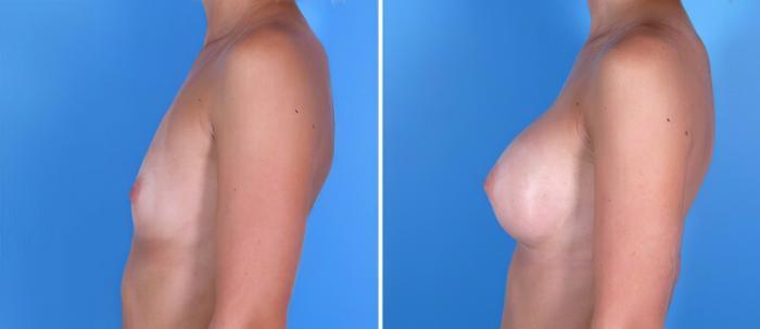 Before & After Breast Augmentation Case 24885 View #2 View in Alpharetta, GA
