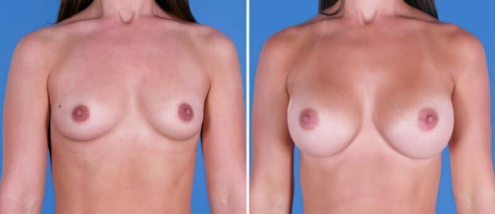 Before & After Breast Augmentation Case 24888 View #1 View in Alpharetta, GA