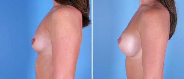 Before & After Breast Augmentation Case 24888 View #2 View in Alpharetta, GA