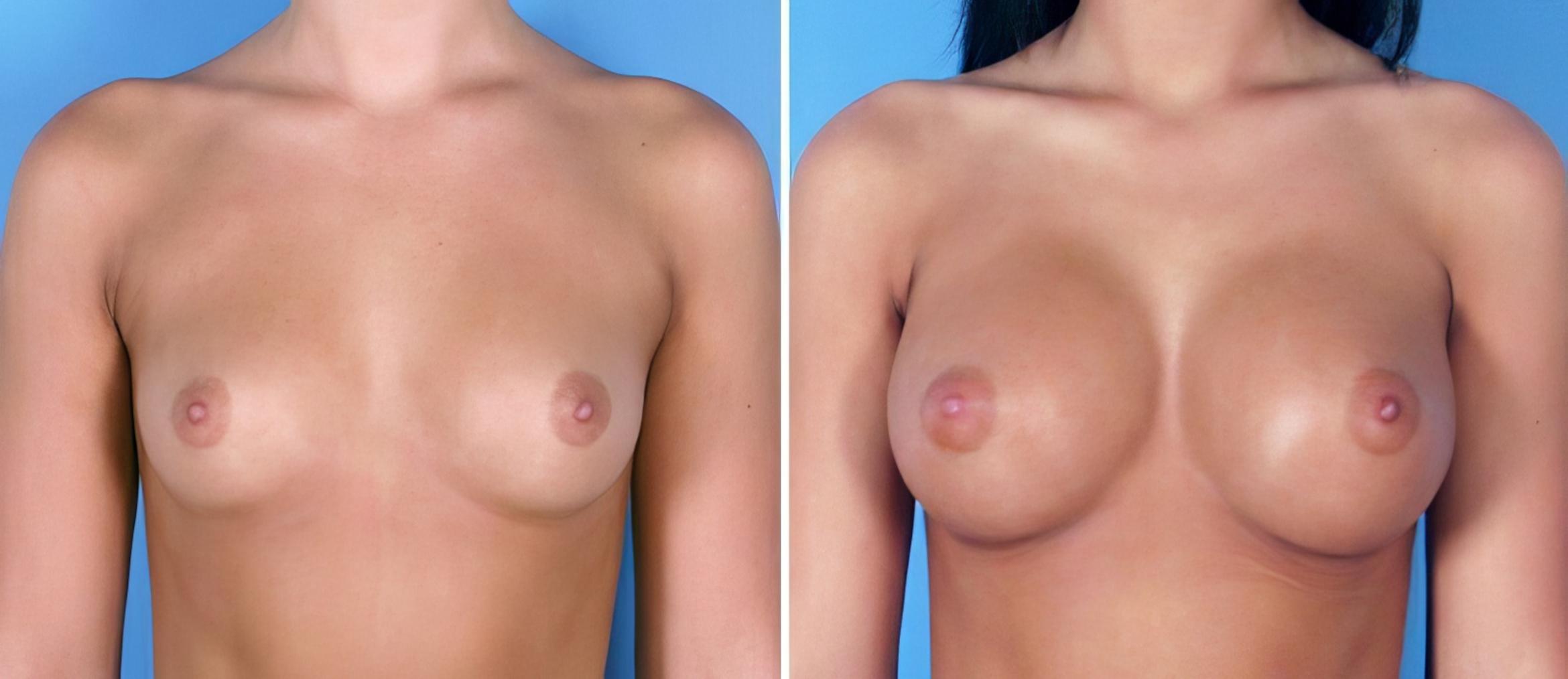 Before & After Breast Augmentation Case 24891 View #1 View in Alpharetta, GA