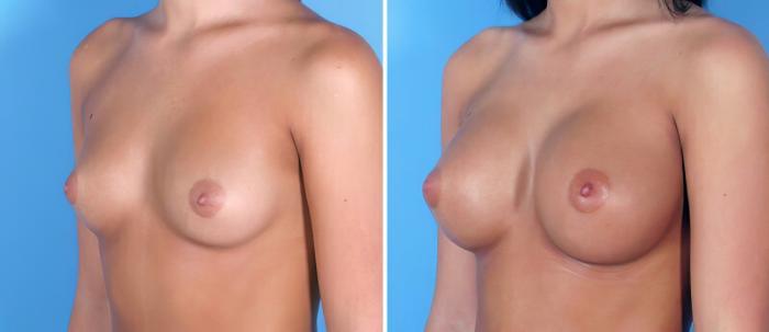 Before & After Breast Augmentation Case 24891 View #2 View in Alpharetta, GA