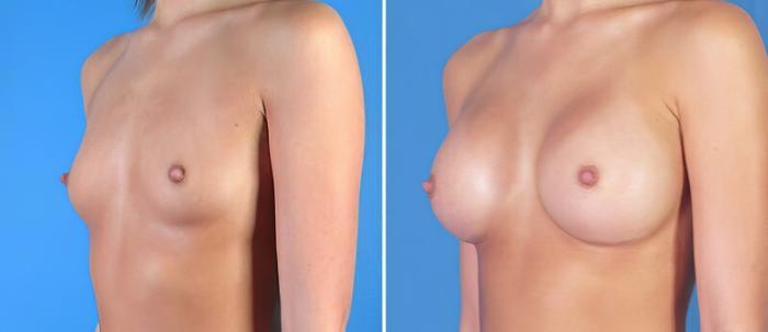 Before & After Breast Augmentation Case 24894 View #2 View in Alpharetta, GA