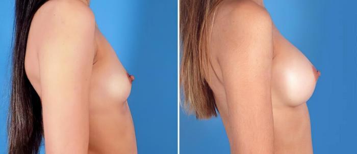 Before & After Breast Augmentation Case 24897 View #2 View in Alpharetta, GA